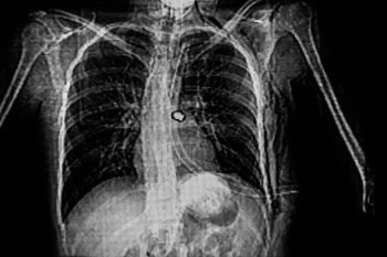 Sonho de levar um tiro no peito – significado e simbolismo